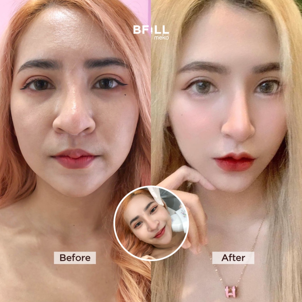 DUO Set Premium Hifu + Thermage Korea By Specialist เซตคู่หู ยกกระชับ พรีเมียมไฮฟู่ + เทอมาจเกาหลี ทำโดยผู้เชี่ยวชาญ
