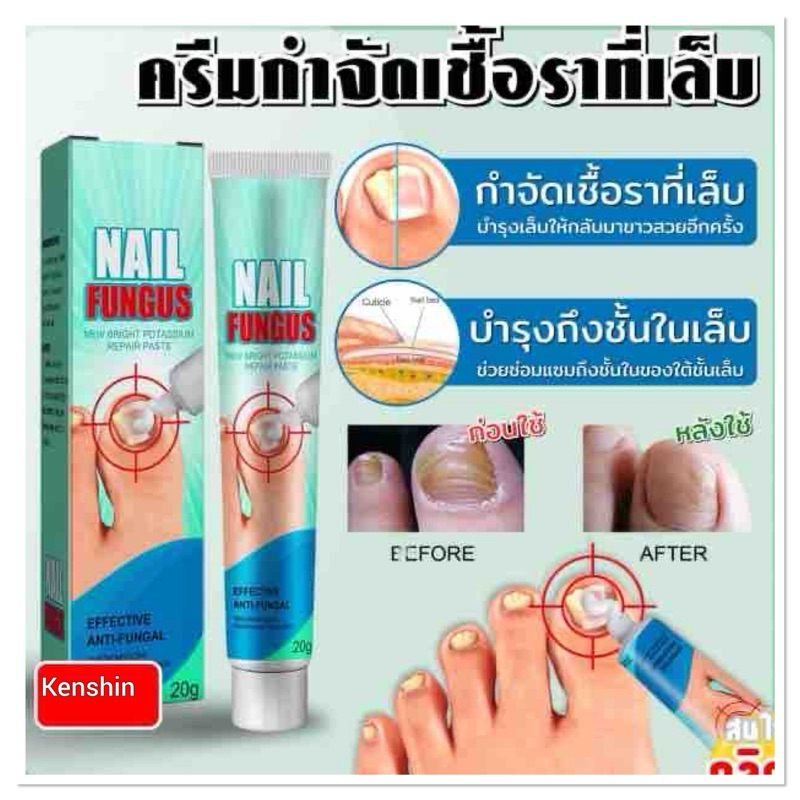 ครีมกำจัดเชื้อราที่เล็บ ขนาด 20 กรัม