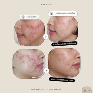 Lovelist เซตลดสิวฟื้นฟูผิว เซรั่ม Herbpy Secret + ครีม Moon Night