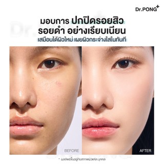 [กด 1 ฟรี 1] Dr.PONG ACNE ACE LONGWEAR CUSHION คุชชั่นลดสิว ยืนยันด้วยงานวิจัย ผิวไม่อุดตัน