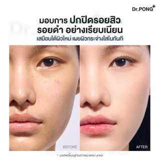 Dr.PONG ACNE ACE LONGWEAR CUSHION คุชชั่นลดสิว ยืนยันด้วยงานวิจัย ผิวไม่อุดตัน