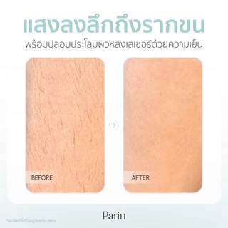 Parin IPL “ICONIC” GEN 4 เครื่องกำจัดขน โหมดเลเซอร์เย็น -8 องศา (999,999 Shot) รับประกัน 2 ปี