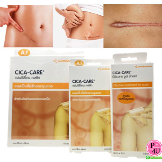 แผ่นซิลิโคน เจลชีท CICA-CARE ลดรอยแผลเป็น cica care สำหรับแผลเป็นที่มีลักษณะนูนแดง มี3ขนาด