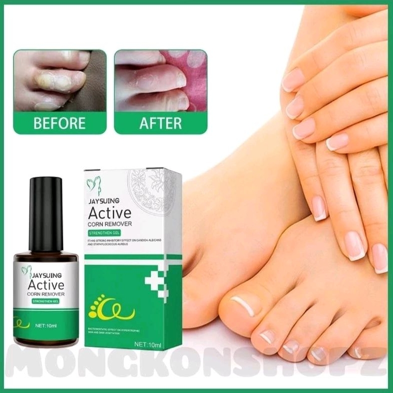 ✓✓ฟรีพลาสเตอร์แปะตาปลา✓✓ แต้มตาปลา ขจัดหูดตาปลา ซึมไว ไม่ทิ้งร่องรอย Wart Removal Corns Foot Care Solution