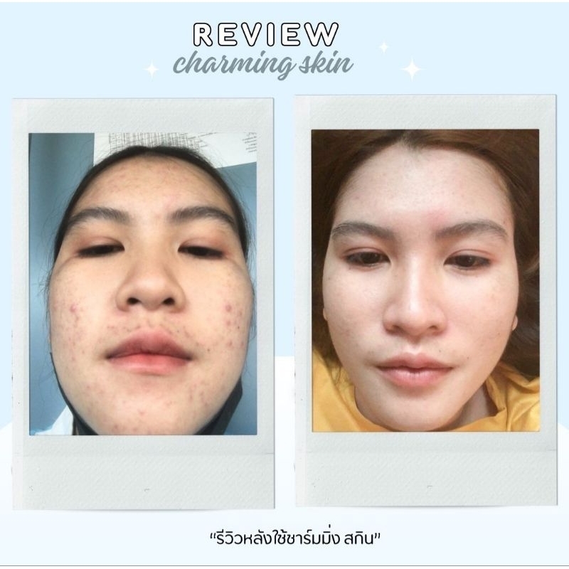 ครีมชาร์มมิ่งสกิน เซรั่มรีเฟรซ [โปร 5ชิ้นและ โปร 10ชิ้น เล็ก CHARMING SKIN SERUM REFRESH- ราคา ถูกที่สุด ดีลบีเคเค แกลเลอรีภาพที่ 6