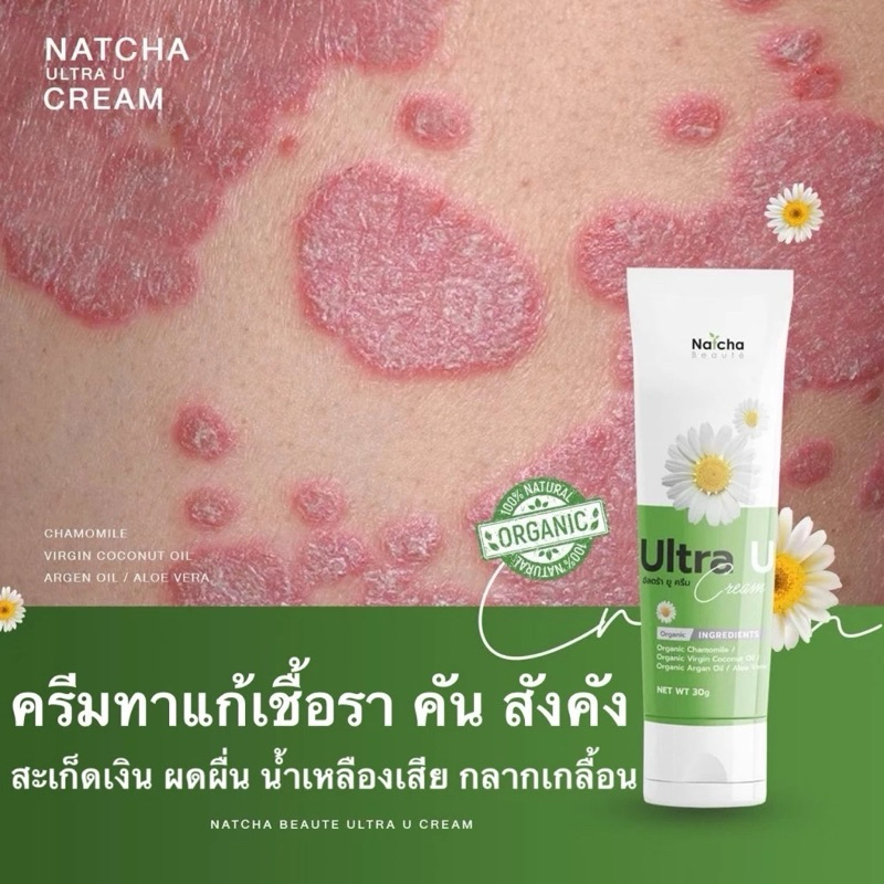 ครีมยูเรีย อัลตร้ายู คัน เชื้อรา ผิวแห้ง 30g.