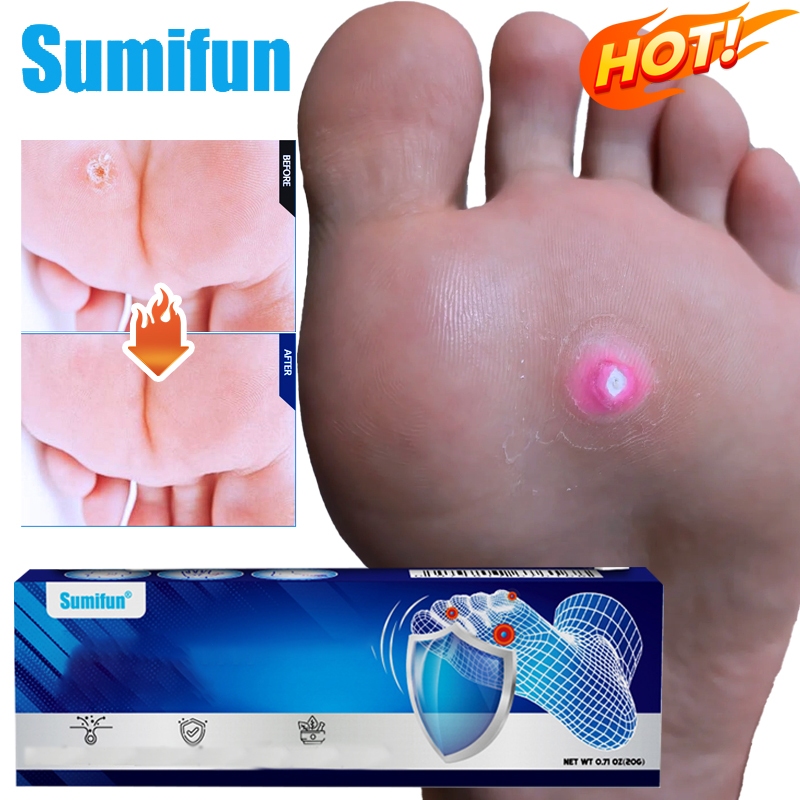 Corn Plaster Removal หูดและติ่ง แคลลัสและรากหนาม ช่วยให้หูดหรือตาปลาหลุดออกเหมาะสำหรับบุคคลที่หูด