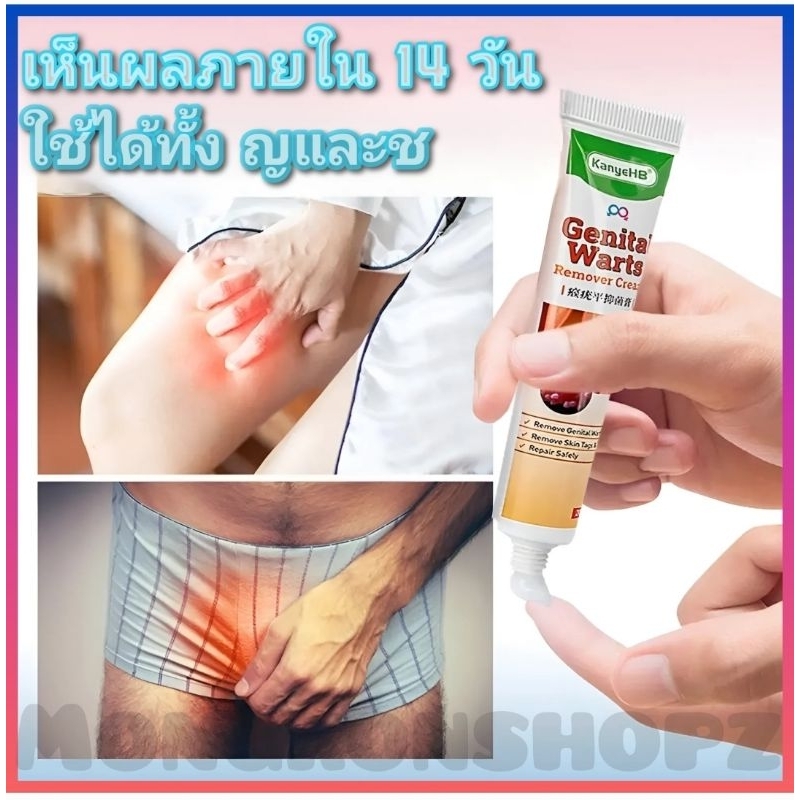 [จัดส่งทันที] ครีมทา หูดหงอนไก่ หูดอุดรูขุมขน ใช้ได้ทั้งหญิงและชาย