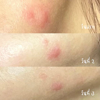 เกรดทางการแพทย์ : IRICH Soft Laser High Frequency+ เครื่องเลเซอร์ฆ่าเชื้อสิว (ผลิตโดย IRICH)