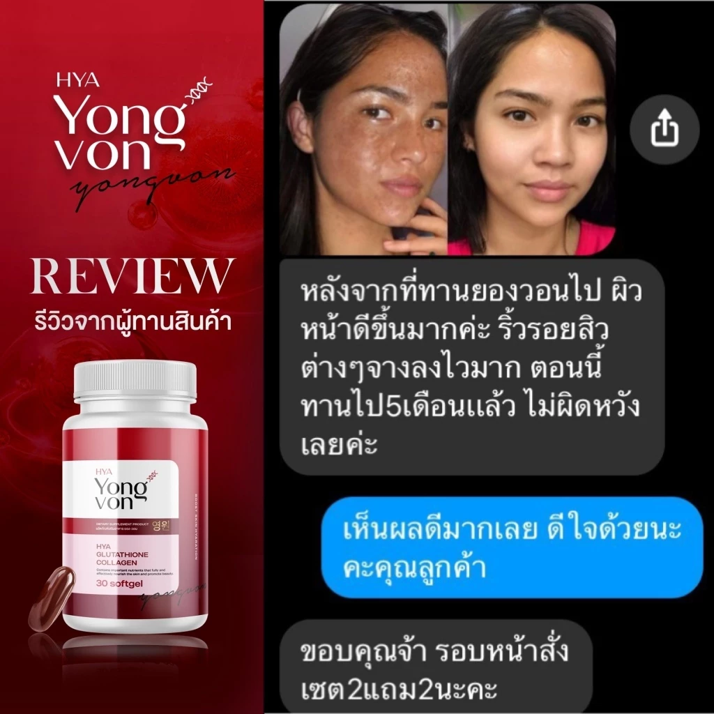 Yong-Von กลูต้า จบปัญหาสิวรอยดำ ผิวสุขภาพดี thumbnail 5