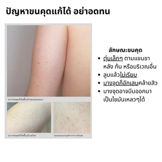 ครีมทาขนคุด KP-CLEAR แก้ปัญหาขนคุดโดยเฉพาะ ร้านofficial แบรนด์อันดับหนึ่งของไทย