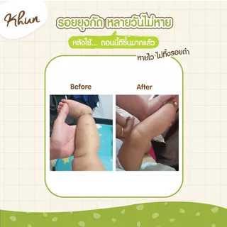 (ร้านแนะนำ) KHUN เจลทากันยุงกัด 10 ml. ทายุงกัด ลดบวม ไม่ทิ้งรอยดำ สูตรออร์แกนิค อ่อนโยน สำหรับเด็ก