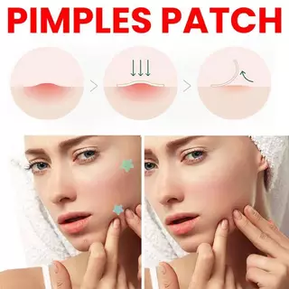 (มีส่งด่วน) JAYSUING PIMPLES PATCH แผ่นแปะสิว ลดจุดด่างดํา ซึมซับสิวอย่างอ่อนโยน 200 PATCHS