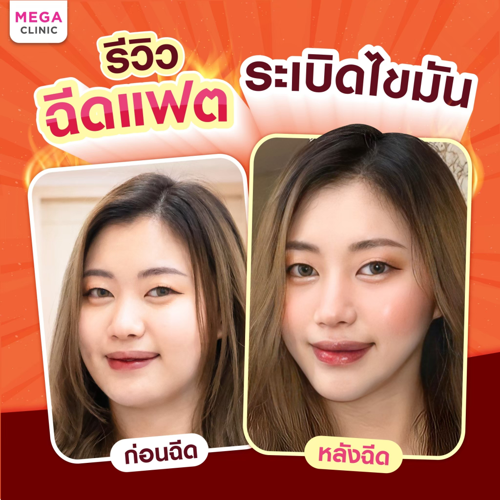 [E-voucher] ฉีดแฟตเข้มข้น ไม่ผสมน้ำเกลือ (แลกซื้อ 99 บาท) จากปกติ 2,900 บาท