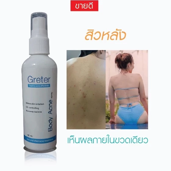 สเปรย์สิวหลังและหน้าเห็นผลเร็ว Greter