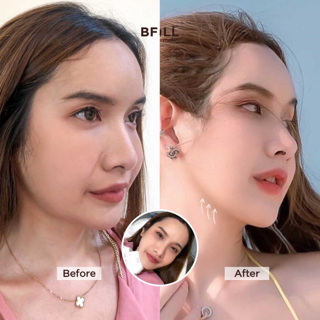 DUO Set Premium Hifu + Thermage Korea By Specialist เซตคู่หู ยกกระชับ พรีเมียมไฮฟู่ + เทอมาจเกาหลี ทำโดยผู้เชี่ยวชาญ