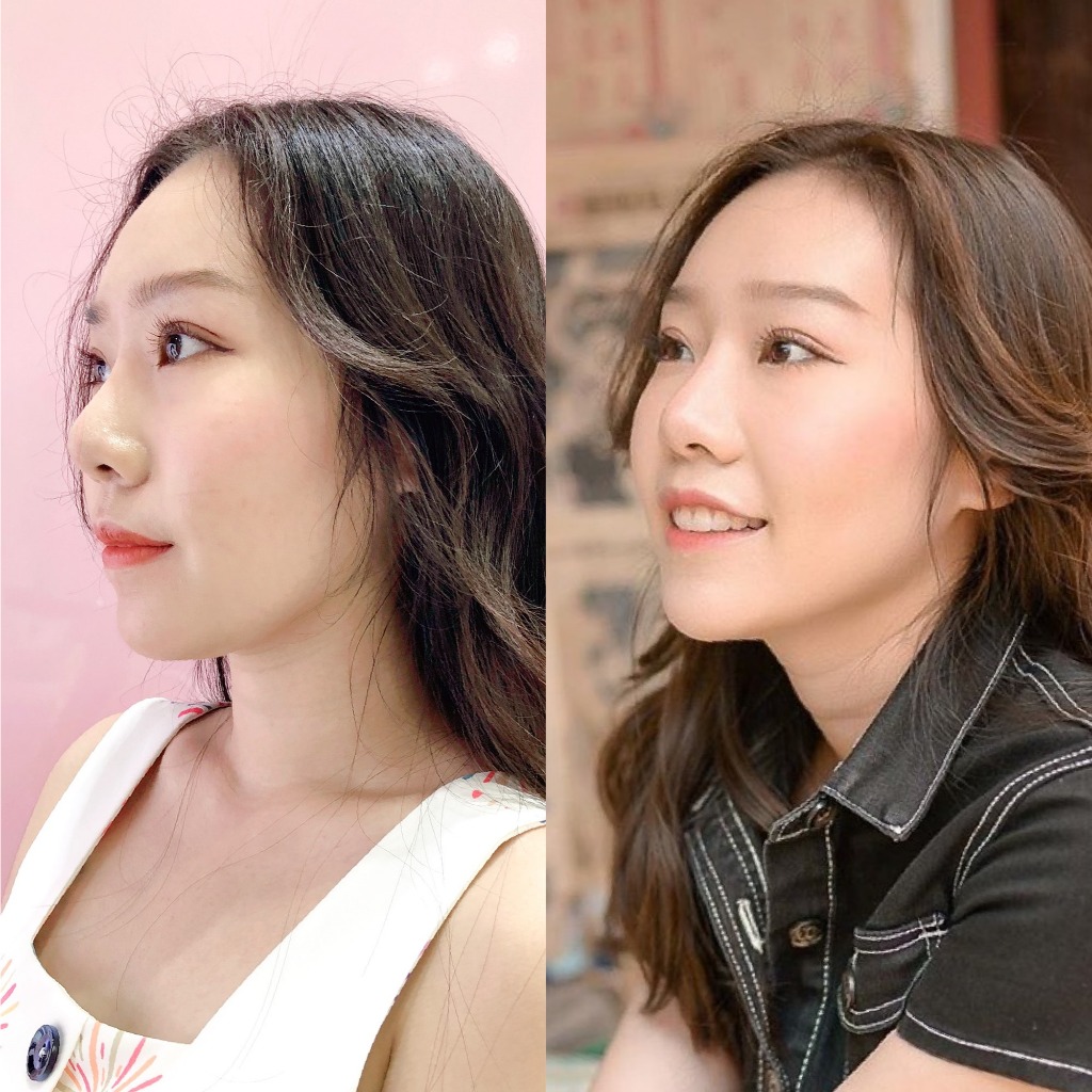 DUO Set Premium Hifu + Thermage Korea By Specialist เซตคู่หู ยกกระชับ พรีเมียมไฮฟู่ + เทอมาจเกาหลี ทำโดยผู้เชี่ยวชาญ