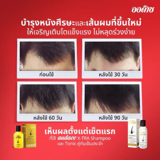 ออด๊าซ เอ็กซ์ทร้า โทนิค สำหรับเส้นผมที่หลุดร่วงง่าย (New Procapil,Biotin)กล่องทอง 200 ml. (หมดอายุปี2028)