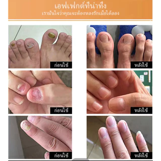 LANBENA เซรั่มบำรุงเล็บ น้ำยาบำรุงเล็บ 15ml บำรุงเล็บ ต่อต้านการติตเชื้อรา ซ่อมแซมเล็บแตก เล็บเปราะ