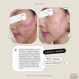 Lovelist เซตลดสิวฟื้นฟูผิว เซรั่ม Herbpy Secret + ครีม Moon Night