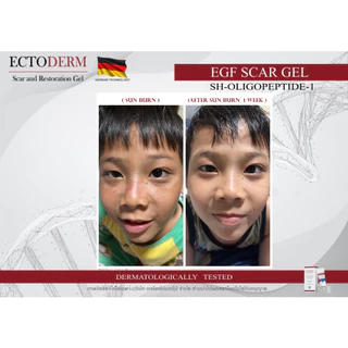 ECTODERM Scar and Restoration รักษาแผลตั้งแต่แรก แผลใหม่แผลหลังผ่าตัดสมานแผลแท้+แถม EXP.15/05/28
