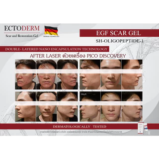 ECTODERM Scar and Restoration รักษาแผลตั้งแต่แรก แผลใหม่แผลหลังผ่าตัดสมานแผลแท้+แถม EXP.15/05/28