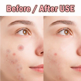 Salicylic Acid แผ่นแปะสิว ช่วยลดอาการอักเสบให้ยุบไว ช่วยดูดสิว รักษาสิว ขอบบาง กันน้ำ แต่งหน้าเนียน