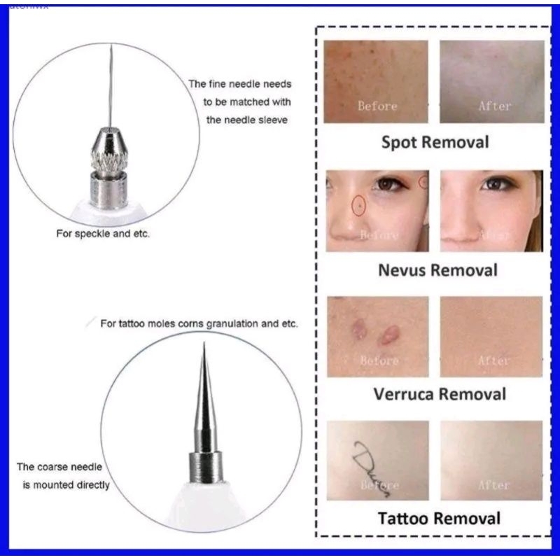 ปากกาเลเซอร์ไฟฟ้า จี้ไฝ ขี้แมลงวัน หูด ติ่งเนื้อ ฝ้า กระ แถมฟรี!ครีมทาก่อนจี้ ครีมทาหลังจี้ เครื่องจี้ไฝ แบบครบเซ็ต! - รูปที่ 2