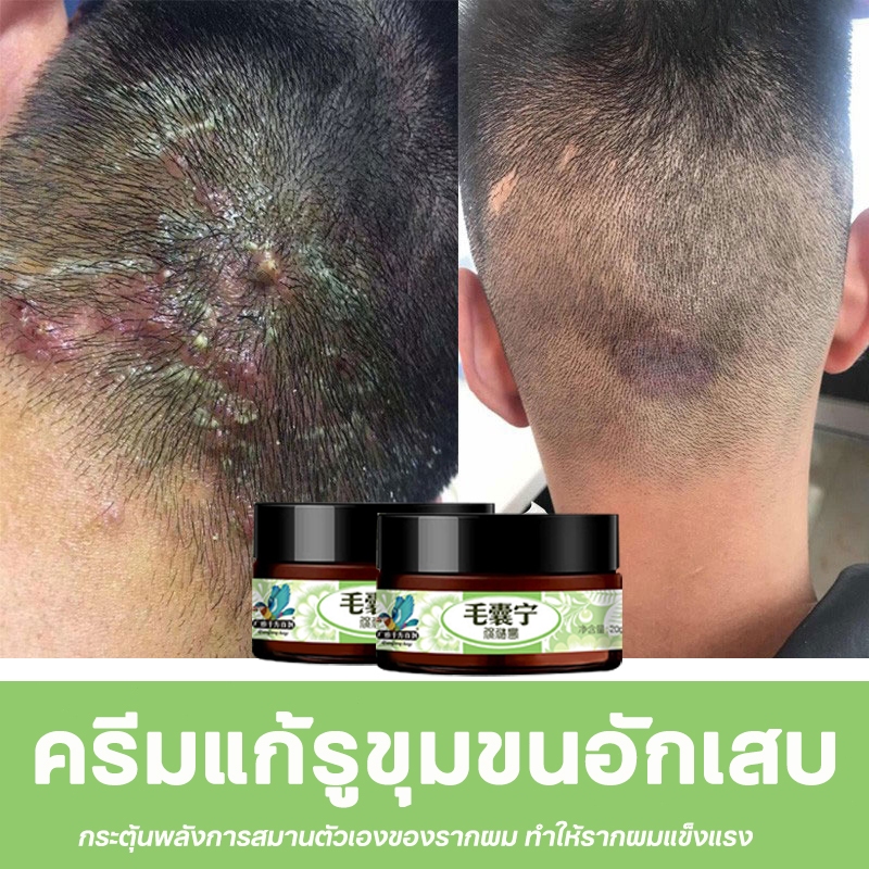 ครีมทารูขุมขนอักเสบ ครีมแก้คัน สิวที่หนังศีรษะ 20g แก้กลากหนังศีรษะ หัว หลัง หน้า ครีมทารูขุมขน