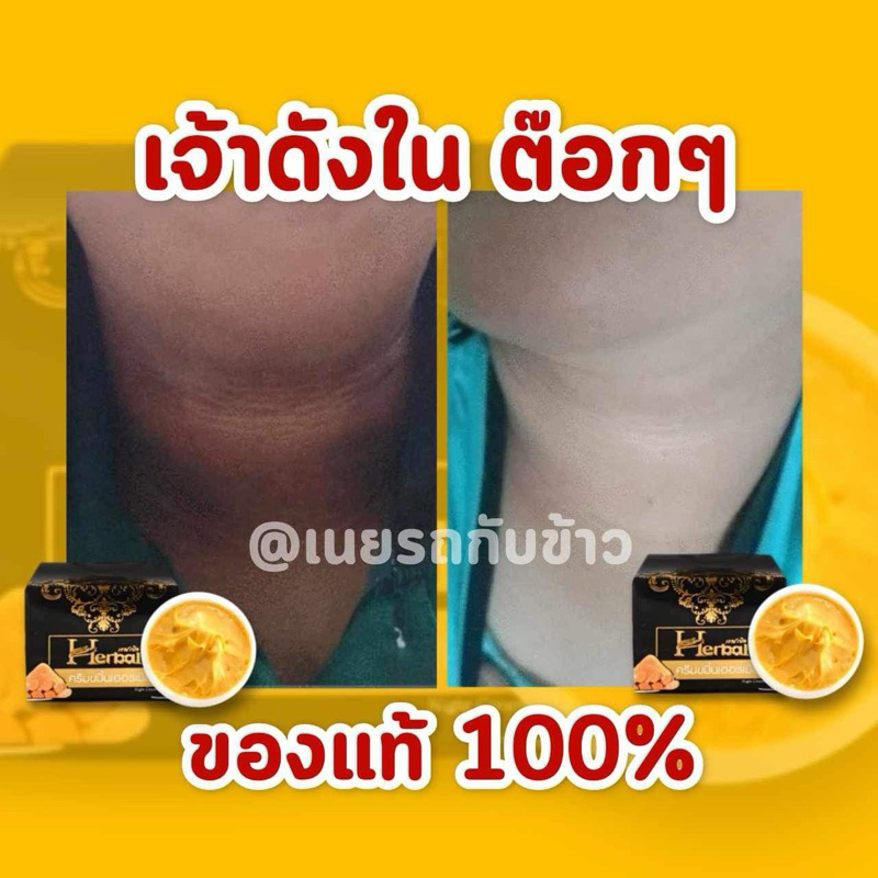 ครีมขมิ้นHerbal ครีมขมิ้นเฮอร์เบิล บำรุงใบหน้า ลดรอยดำ คอดำ ขาหนีบดำ จักแร้ดำ (แท้จากบริษัท)