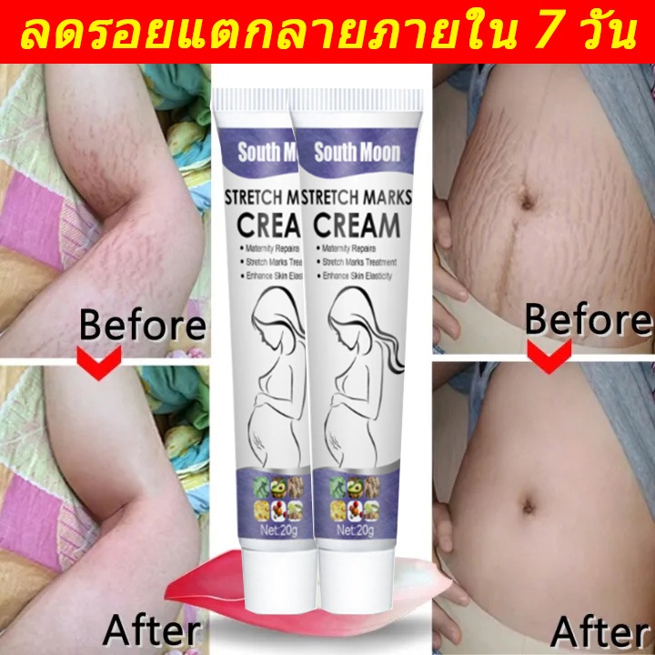 ใช้ได้ทั้งรอยแตกลายใหม่และเก่า ครีมรอยแตกลาย สเปรย์ลดรอยแตกลาย รอยแตกลาย สำหรับการซ่อมแซมผิวหลังคลอด ลดรอยแตกลาย หน้าท