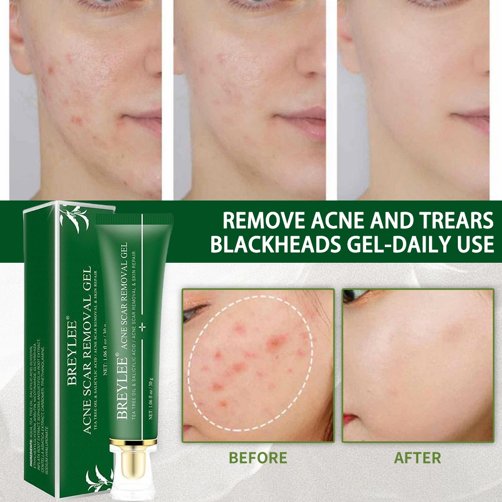 BREYLEE Acne Scars Gel ลบรอยสิว เจล FDA ยาลดสิว ลดรอยสิว ครีมลดสิว ครีมลดรอยสิว ครีมลบรอยสิว Remove Acne Scars