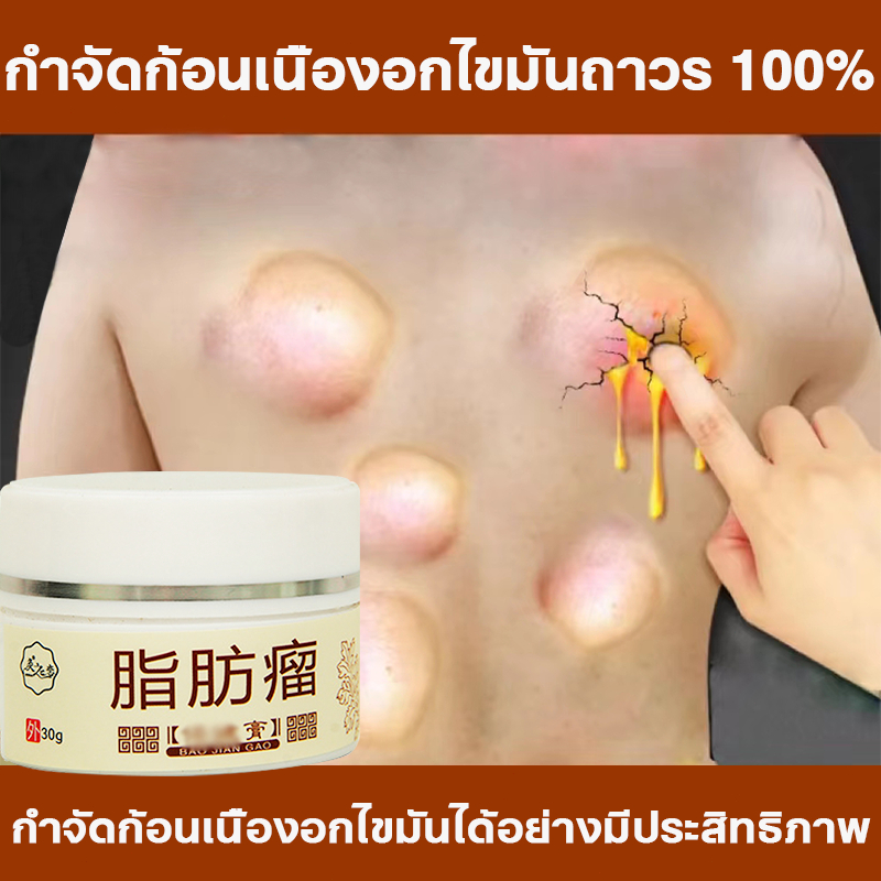 ครีมกำจัดก้อนซีส ครีมกระชับสัดส่วน ครีมสลายไขมัน 30g กำจัดก้อนไขมัน ก้อนไขมันแข็ง ก้อนเนื้อใต้ผิวหนัง ก้อนเนื้องอกไขมัน