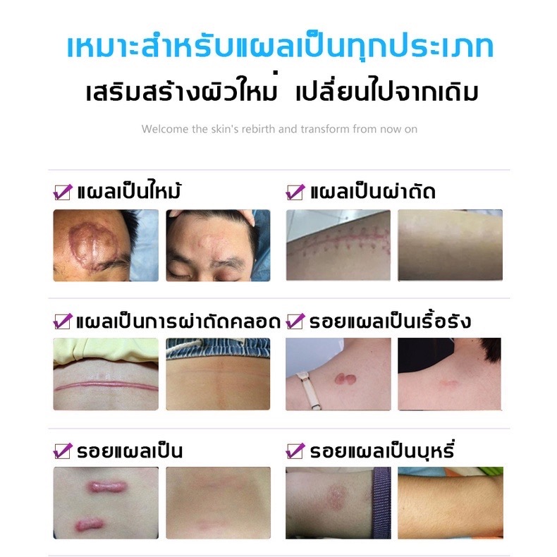 South Moon รักษารอยแผลเป็น แผ่นแปะแผลเป็น 4cm*150cm กําจัดรอยแผลเป็นจากแผลเป็น เผยผิวเนียนสวย - รูปที่ 4
