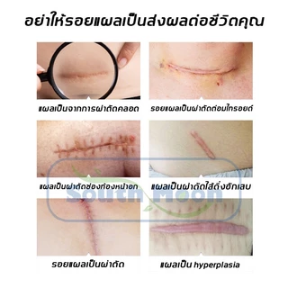 【จัดส่งจากกรุงเทพฯ】South Moon รักษารอยแผลเป็น แผ่นแปะแผลเป็น 4cm*150cm กําจัดรอยแผลเป็นจากแผลเป็น เผยผิวเนียนสวย