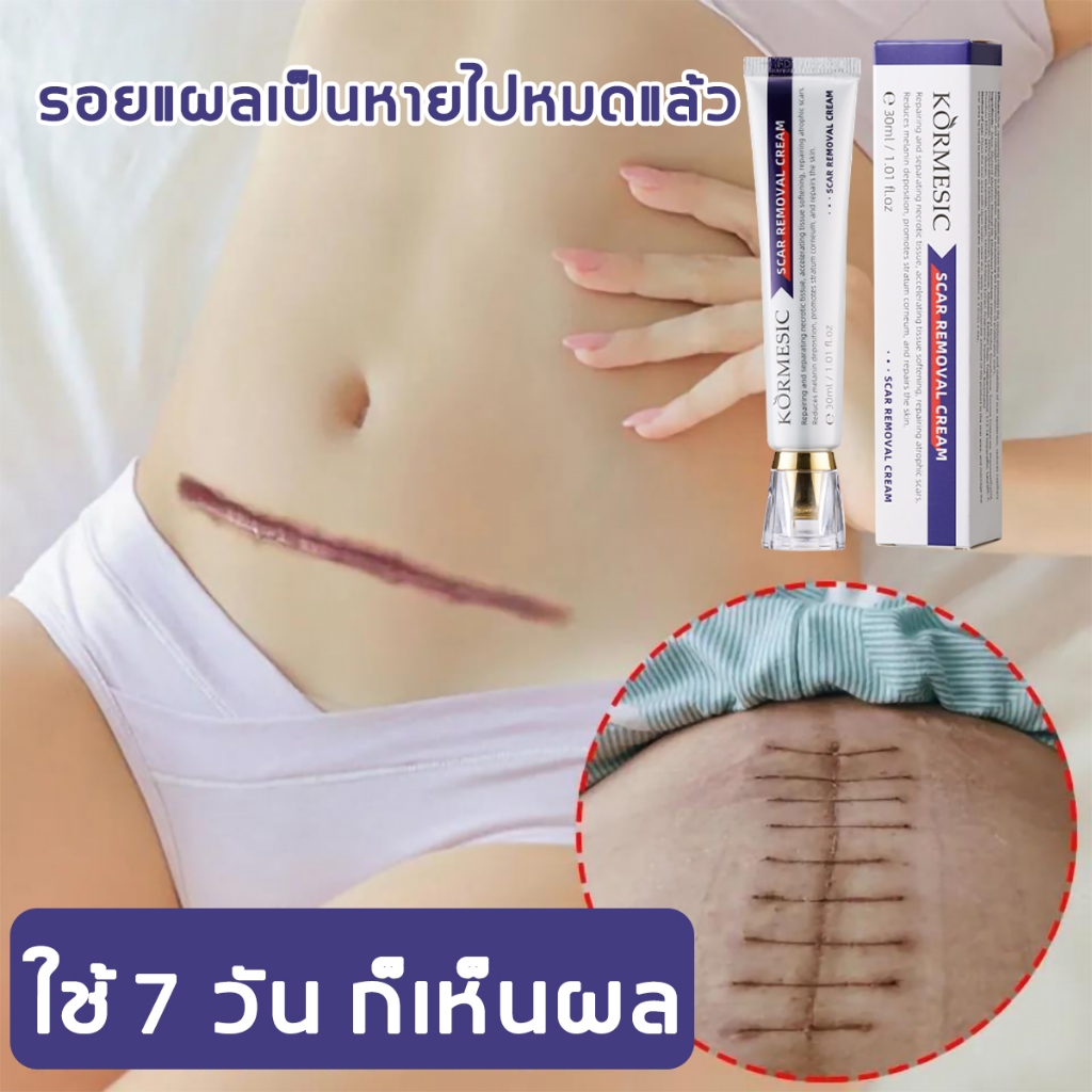KORMESIC ครีมลดรอยแผลเป็น แผลเป็น แผลเป็นใหม่และแผลเป็นเก่า 30ml