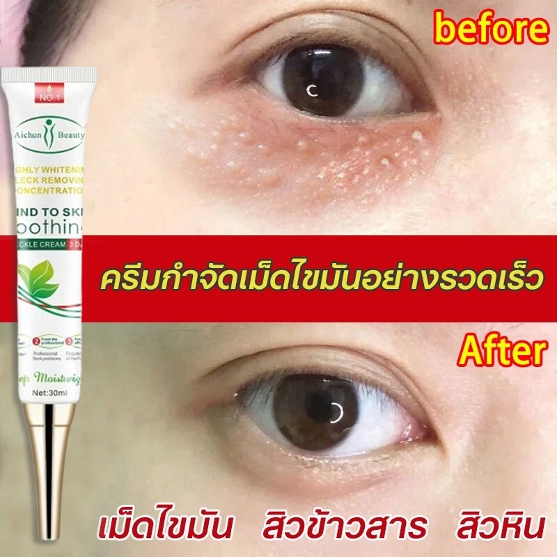 ครีมบำรุงรอบตา ครีมทาตาเม็ดไขมัน ขจัดเม็ดไขมัน 30ml ครีมกำจัดสิวข้าวสาร สิวเม็ดข้าวสาร สิวหิน ขจัดเม็ดไขม ซ่อมแซมผิว