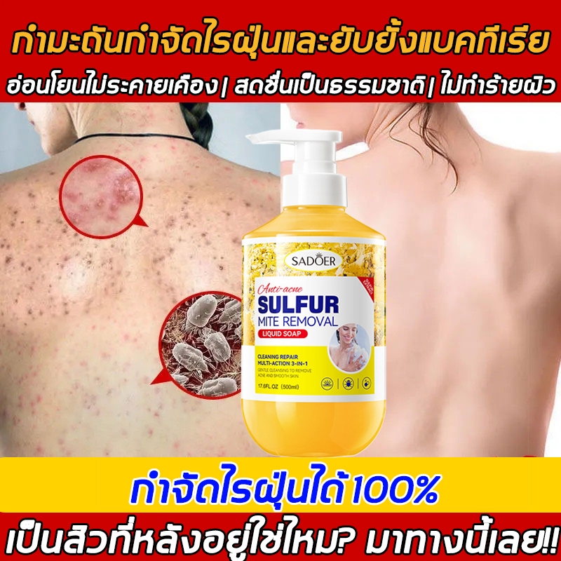 Sulfur สบู่เหลว สบู่ลดสิว ครีมอาบน้ํา ลดสิว ลดสิวอุดตัน สิวที่หลัง กำจัดไร ปรับปรุงผิวคัน ให้ความชุ่มชื้นอ่อนโยน 500ML