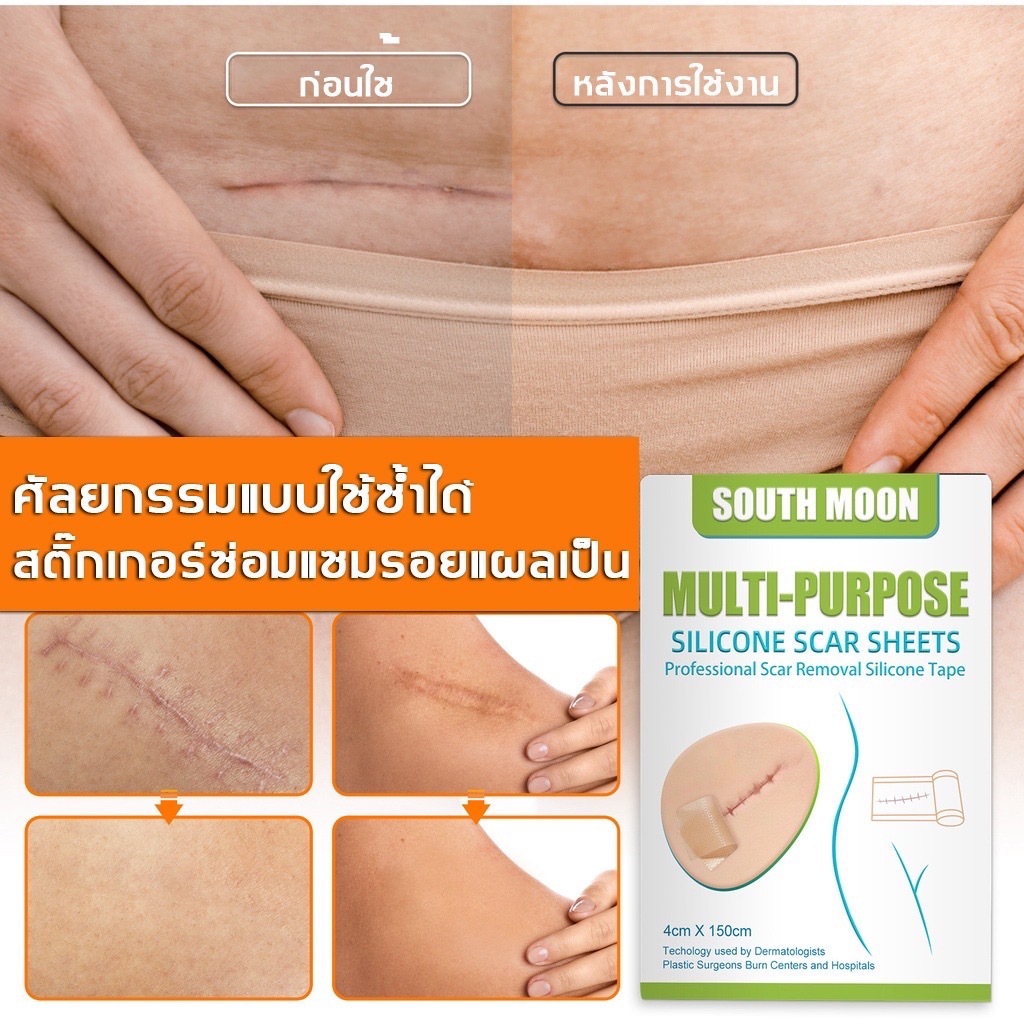 South Moon รักษารอยแผลเป็น แผ่นแปะแผลเป็น 4cm*150cm กําจัดรอยแผลเป็นจากแผลเป็น เผยผิวเนียนสวย - รูปที่ 6
