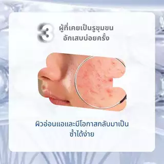 Sanderma เจลอาบน้ำ สูตรอ่อนโยน ฟื้นฟูผิวแพ้ง่าย ลดการอักเสบ ระคายเคืองและรอยแดง 300g