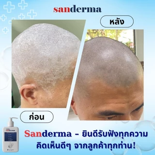 SANDERMA แชมพูรักษา ‘เชื้อรา โรคสะเก็ดเงิน ลดอาการคัน ขจัดรังแค ปัญหาน้ามรัง’