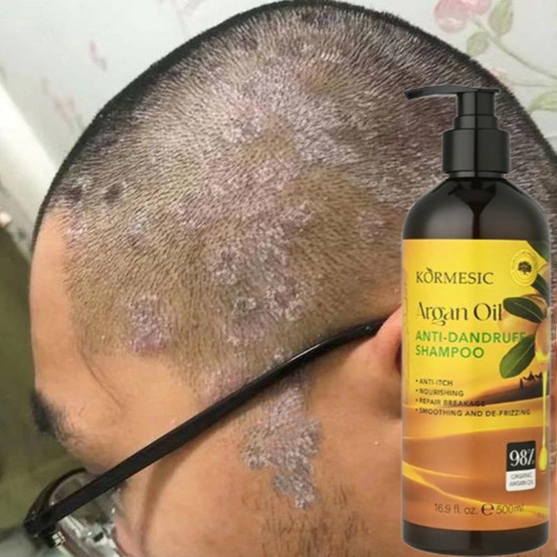 ซื้อ 1 แถม 1 ยาสระผมขจัดรังแค แชมพูแก้คัน แชมพูยาเชื้อรา 500ml แชมพูแก้คันหนังศรีษะ ขจัดรังแค ควบคุมความมัน ขจัดรังแค