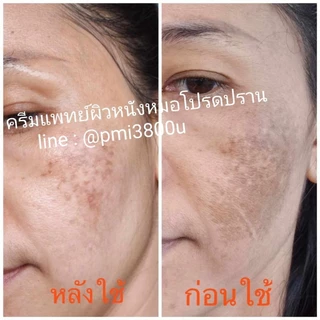 ครีมฝ้ากระหมอโปรดปราน