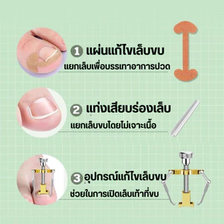 สติ๊กเกอร์เล็บขบ งุ้ม ม้วน เทปแปะกันเล็บขบเนื้อ แผ่นแปะเล็บขบ เล็บฝังลึกนิ้วเท้า 1ชุด มี4ชิ้น พร้อมส่ง