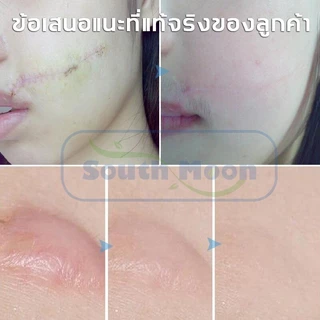 【จัดส่งจากกรุงเทพฯ】South Moon รักษารอยแผลเป็น แผ่นแปะแผลเป็น 4cm*150cm กําจัดรอยแผลเป็นจากแผลเป็น เผยผิวเนียนสวย