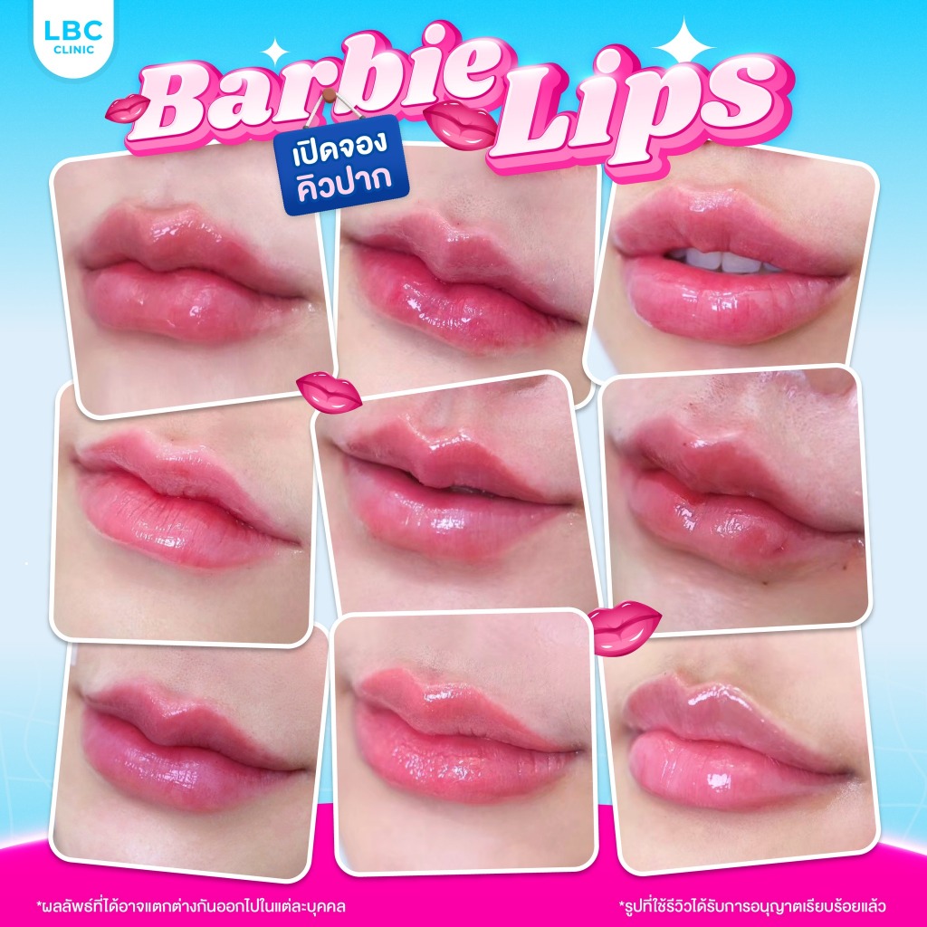 LBC Clinic โปรเติมฟิลเลอร์ปาก ฟิลเลอร์ยุโรป 1 cc