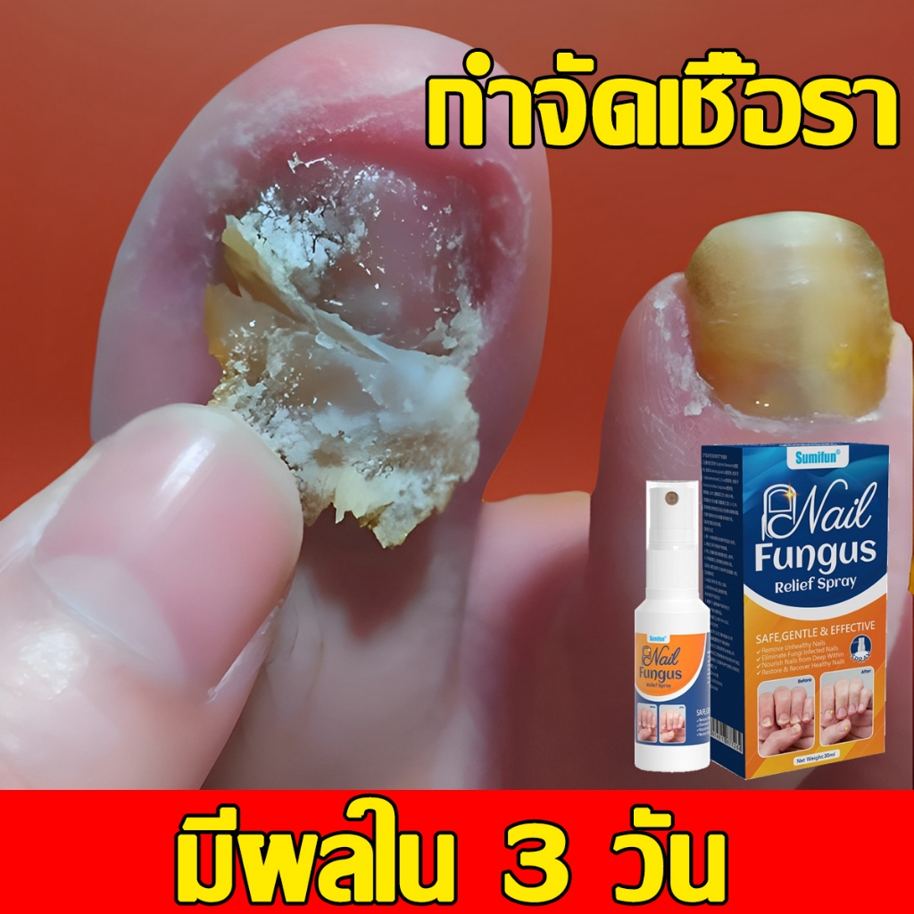เซรั่มบำรุงเล็บ Sumifun รักษาเชื้อราเล็บ รักษาเล็บขบ ฆ่าเชื้อราที่เล็บ น้ำยาบำรุงเล็บ เชื้อราที่เล็บ