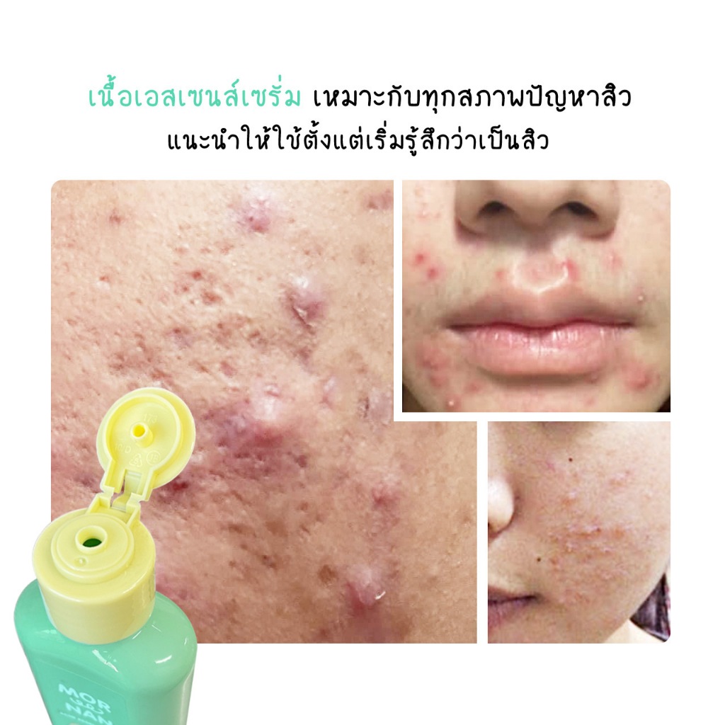 หมอแนน แอคเน่ เอสเซนส์ เซรั่ม เมก้าด็อกเตอร์แนน ขนาด 120 ml. สำหรับทาสิวทุกชนิดแบบเร่งด่วน เย็นผิว - รูปที่ 6