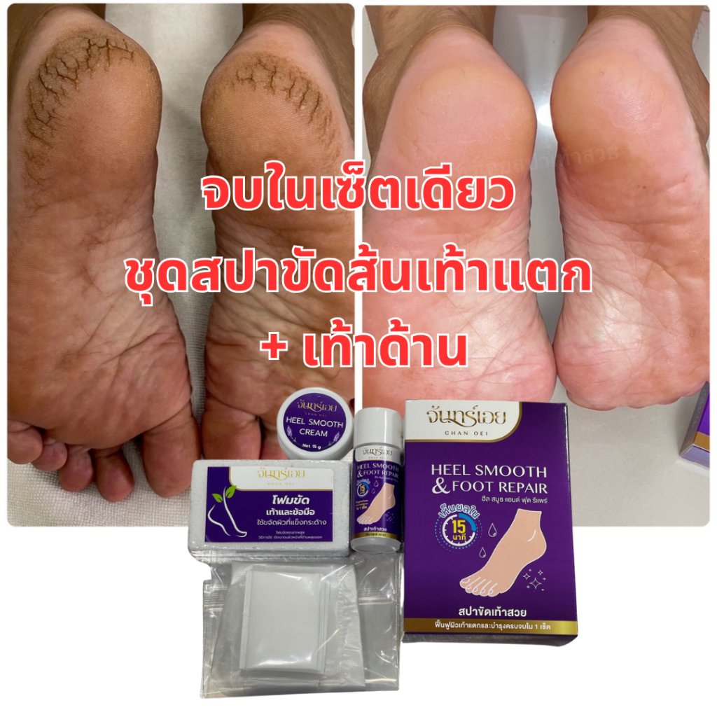 เซ็ตขัดส้นเท้า สปาเท้าแตก ชุดขัดส้นเท้าแตก แก้หนังด้าน ตาตุ่มดำ จันทร์เอย ครบจบในกล่องเดียว