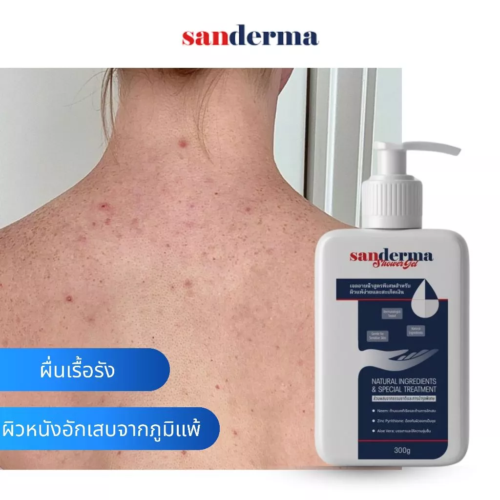 Sanderma เจลอาบน้ำ สูตรอ่อนโยน ฟื้นฟูผิวแพ้ง่าย ลดการอักเสบ ระคายเคืองและรอยแดง 300g